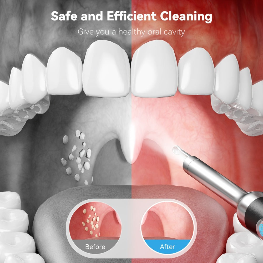Intelligent Visual Tonsil Stone Removal Kit – 1080P HD Camera, 6 LED Lights, Wi-Fi & App Connection, Multi-Accessory Oral Inspection Tool for All Ages - product image 2